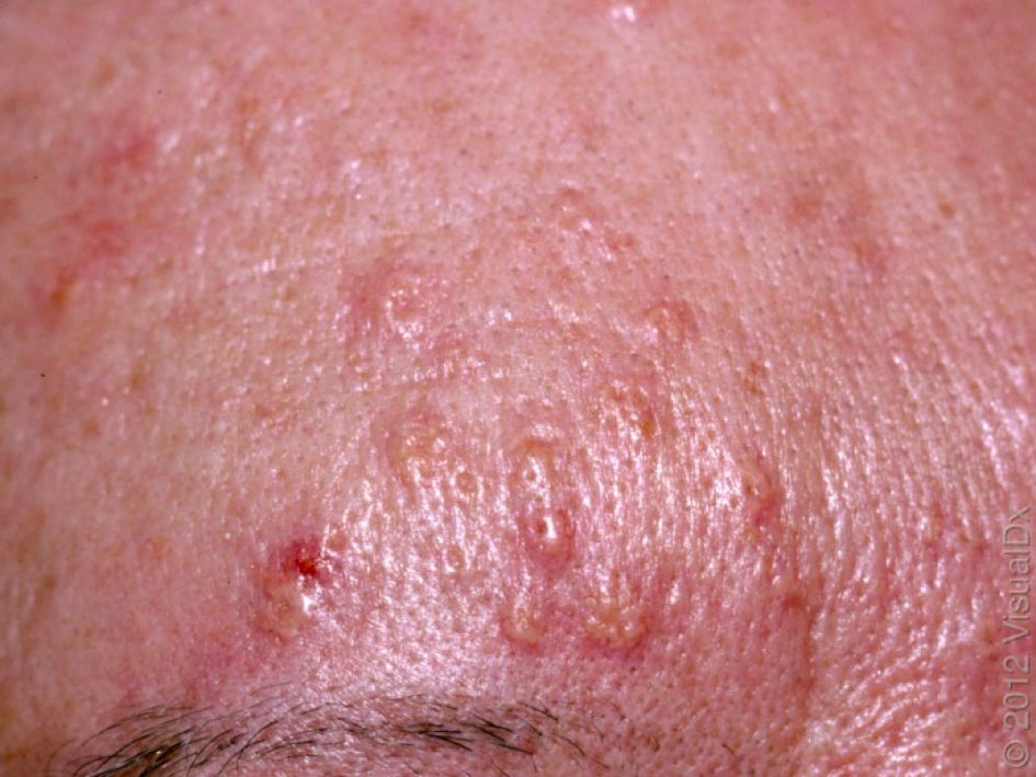 哪种皮肤病容易被误判为银屑病,容易被误诊为疥疮的皮肤病