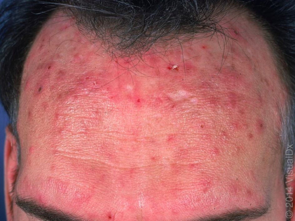 哪种皮肤病容易被误判为银屑病,容易被误诊为疥疮的皮肤病