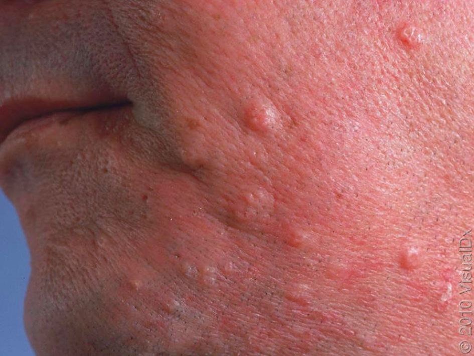 哪种皮肤病容易被误判为银屑病,容易被误诊为疥疮的皮肤病