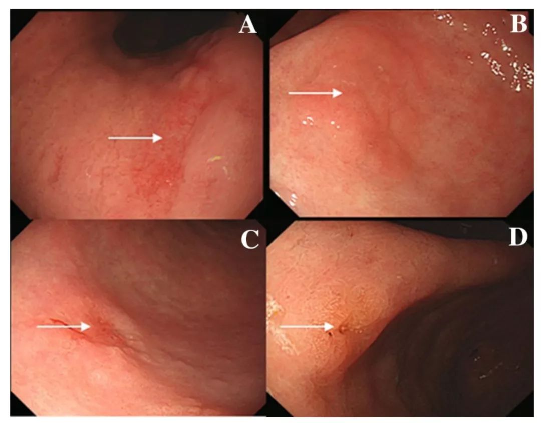 胃镜低级别上皮内瘤变如何治疗,胃镜高级别上皮内瘤变是什么意思