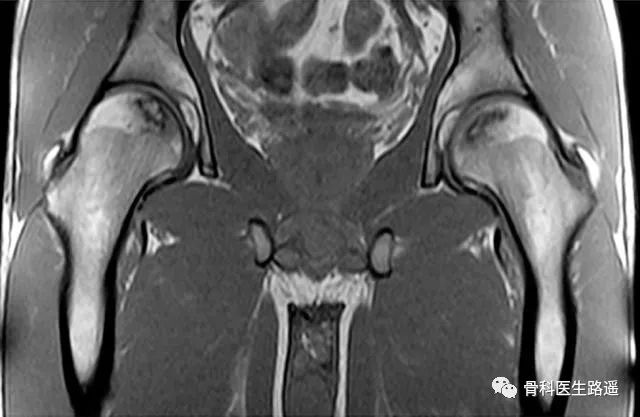 全髋置换最新技术,人工髋关节置换后可以正常跑步