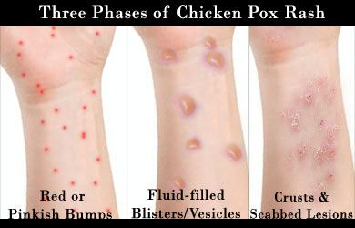 水痘会不会致死,水痘要人命吗