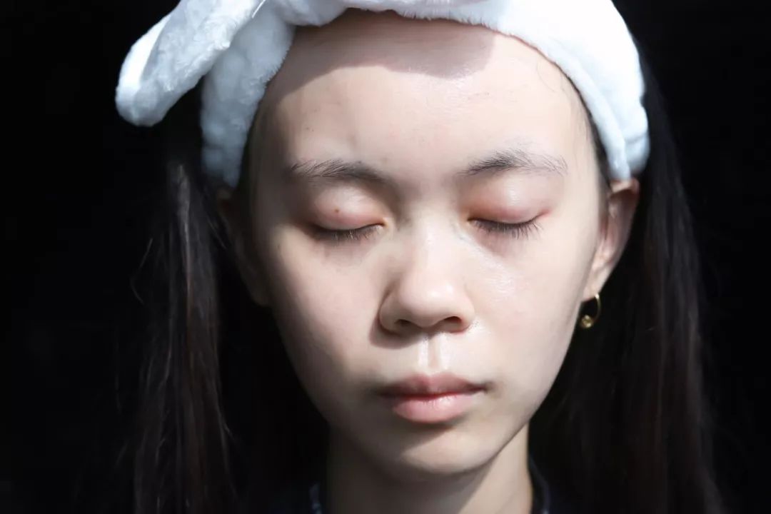 痘痘黑头清理方法,彻底解决痘痘黑头