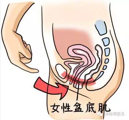 尴尬的社交癌——女性盆底功能障碍性疾病
