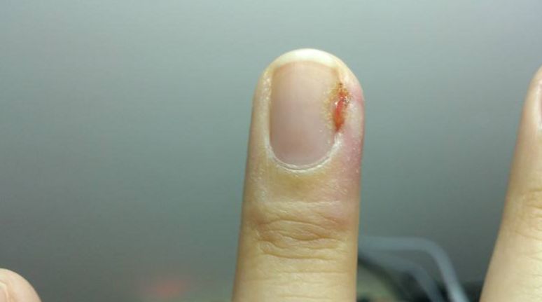 真不是吓唬你！撕“倒戗刺”可能会导致截指，你信吗？｜男子拇指扎根小刺差点丢了手指