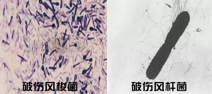 被咬伤感染狂犬病的概率,狂犬病和破伤风的表现有何不同