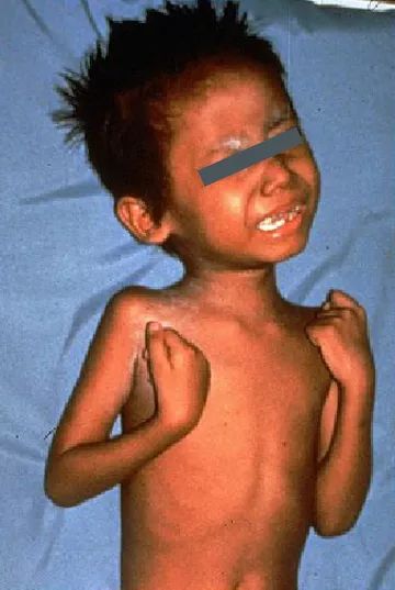 被咬伤感染狂犬病的概率,狂犬病和破伤风的表现有何不同