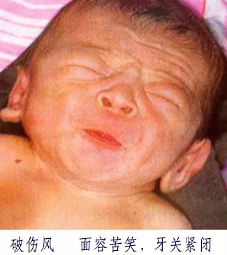 被咬伤感染狂犬病的概率,狂犬病和破伤风的表现有何不同