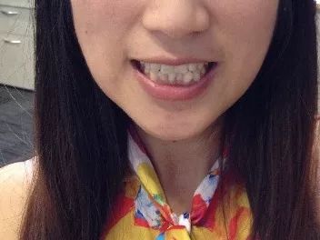 怀孕可以做乳房矫正吗,30岁哺乳期矫正牙齿的利与弊