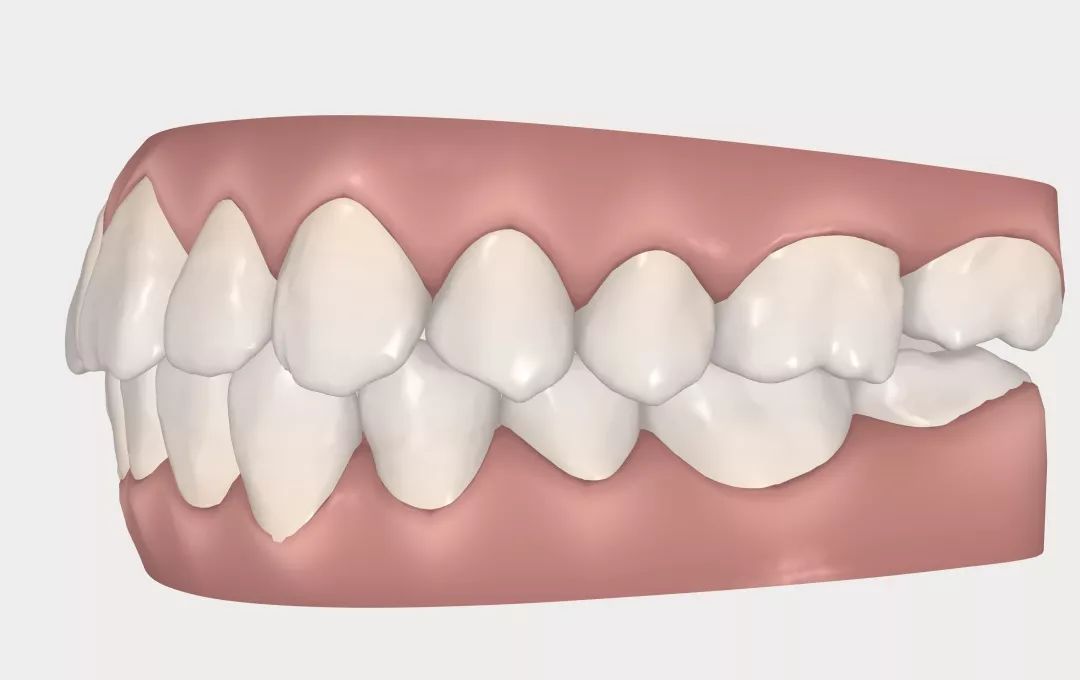 怀孕可以做乳房矫正吗,30岁哺乳期矫正牙齿的利与弊