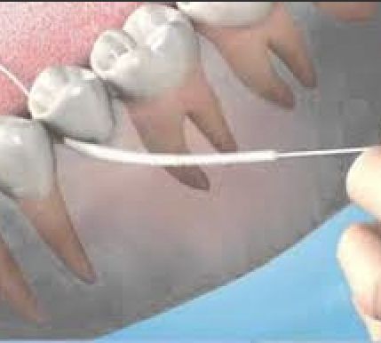 怀孕可以做乳房矫正吗,30岁哺乳期矫正牙齿的利与弊