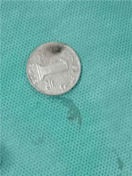 11岁男孩误吞硬币怎么办,1岁多孩子误吞硬币怎么办