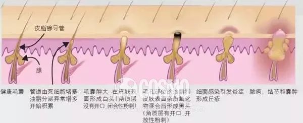 美人计|顽固一年的闭口终于在夏天之前消退了,我用了这些