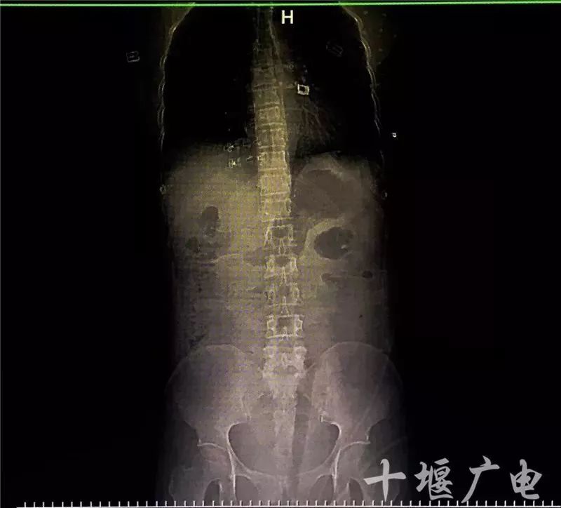 十堰女子骑在树上摘樱桃，结果子宫被切除！还从腹腔取出了...