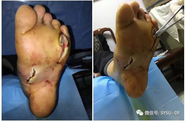 负压吸引糖尿病足的应用,负压滴灌治疗糖尿病足优势是什么