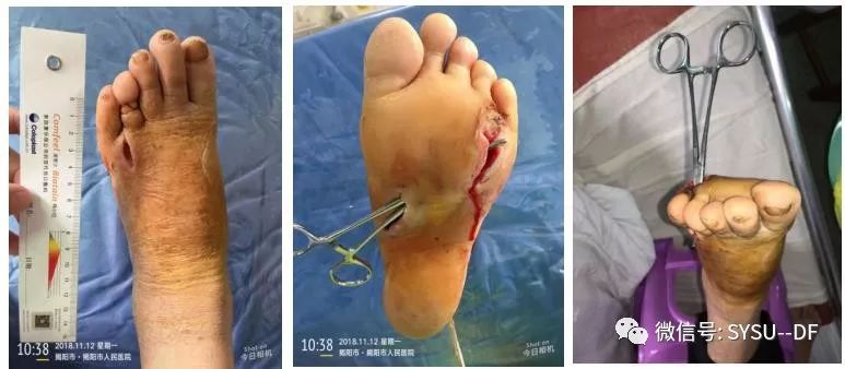 负压吸引糖尿病足的应用,负压滴灌治疗糖尿病足优势是什么