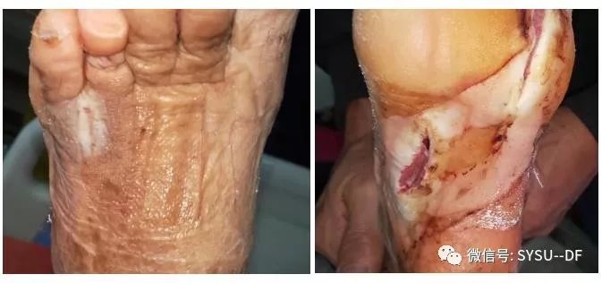 负压吸引糖尿病足的应用,负压滴灌治疗糖尿病足优势是什么