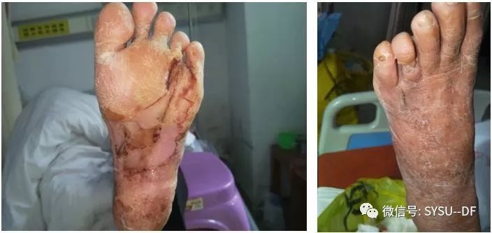 负压吸引糖尿病足的应用,负压滴灌治疗糖尿病足优势是什么