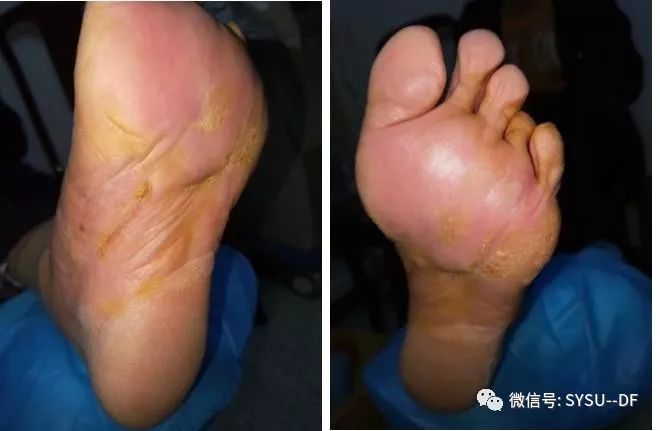 负压吸引糖尿病足的应用,负压滴灌治疗糖尿病足优势是什么