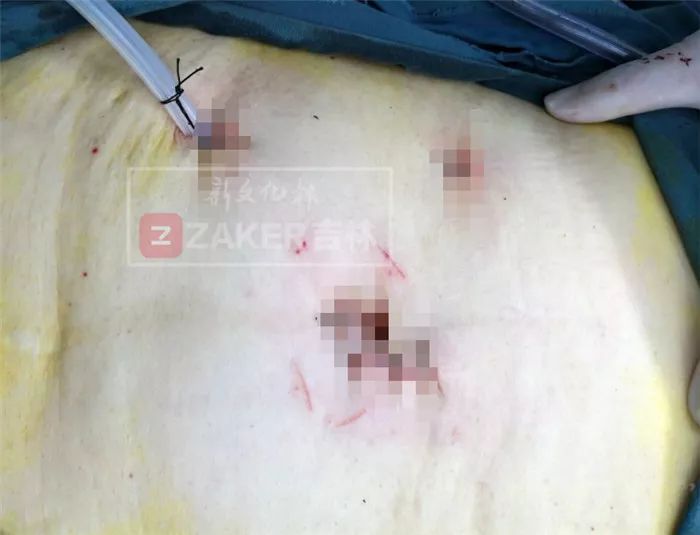 大爷误吞假牙完整版,大爷误吞假牙的视频