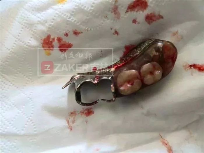 大爷误吞假牙完整版,大爷误吞假牙的视频