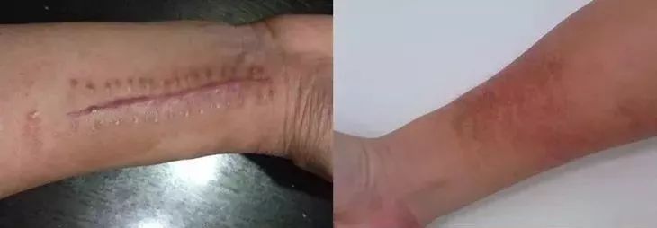 疤痕彻底消失新技术,疤痕淡化修复新技术