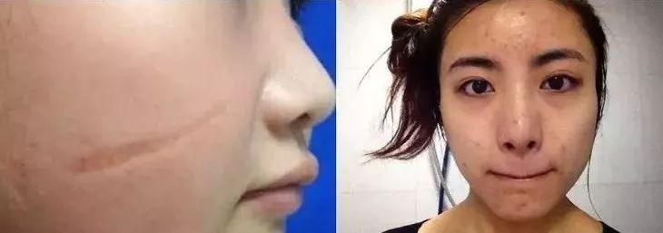 疤痕彻底消失新技术,疤痕淡化修复新技术