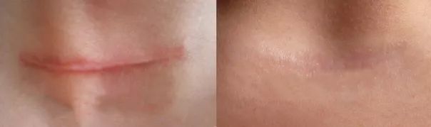 疤痕彻底消失新技术,疤痕淡化修复新技术