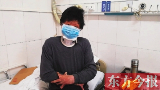 18岁小伙救人被火重度烧伤,救火救人小伙被大面积烧伤