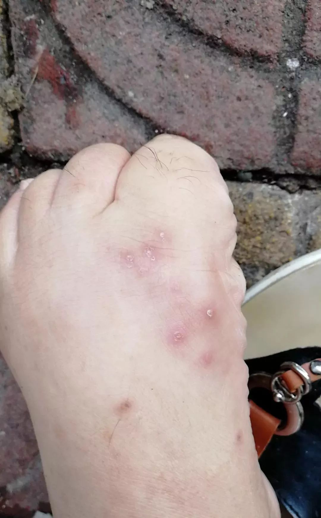 广西一女子被蚂蚁咬伤后不幸身亡,女子被蚂蚁咬伤后续