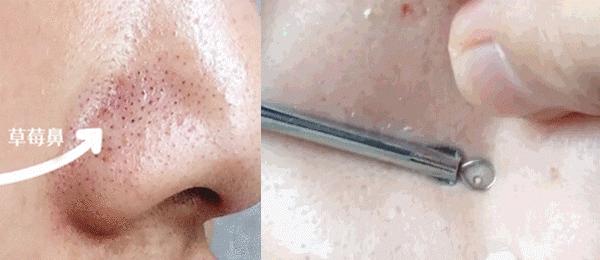 鼻头总是挤出白色丝条中医辨证,鼻头一挤就有白丝