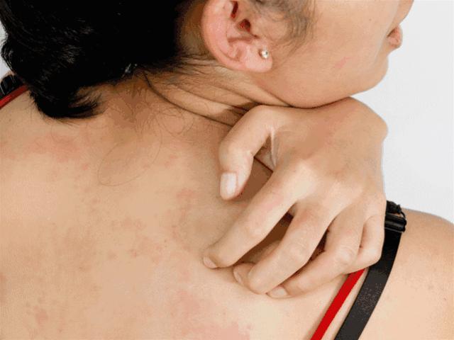 鼻头总是挤出白色丝条中医辨证,鼻头一挤就有白丝