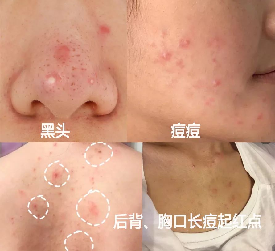 鼻头总是挤出白色丝条中医辨证,鼻头一挤就有白丝