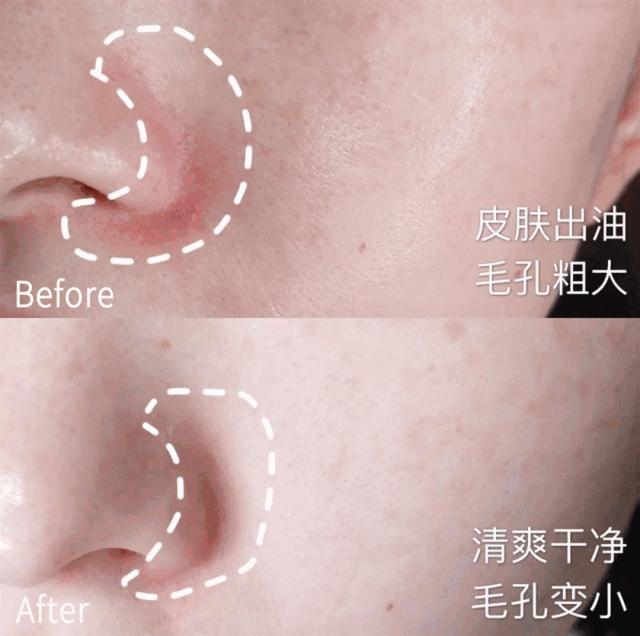 鼻头总是挤出白色丝条中医辨证,鼻头一挤就有白丝