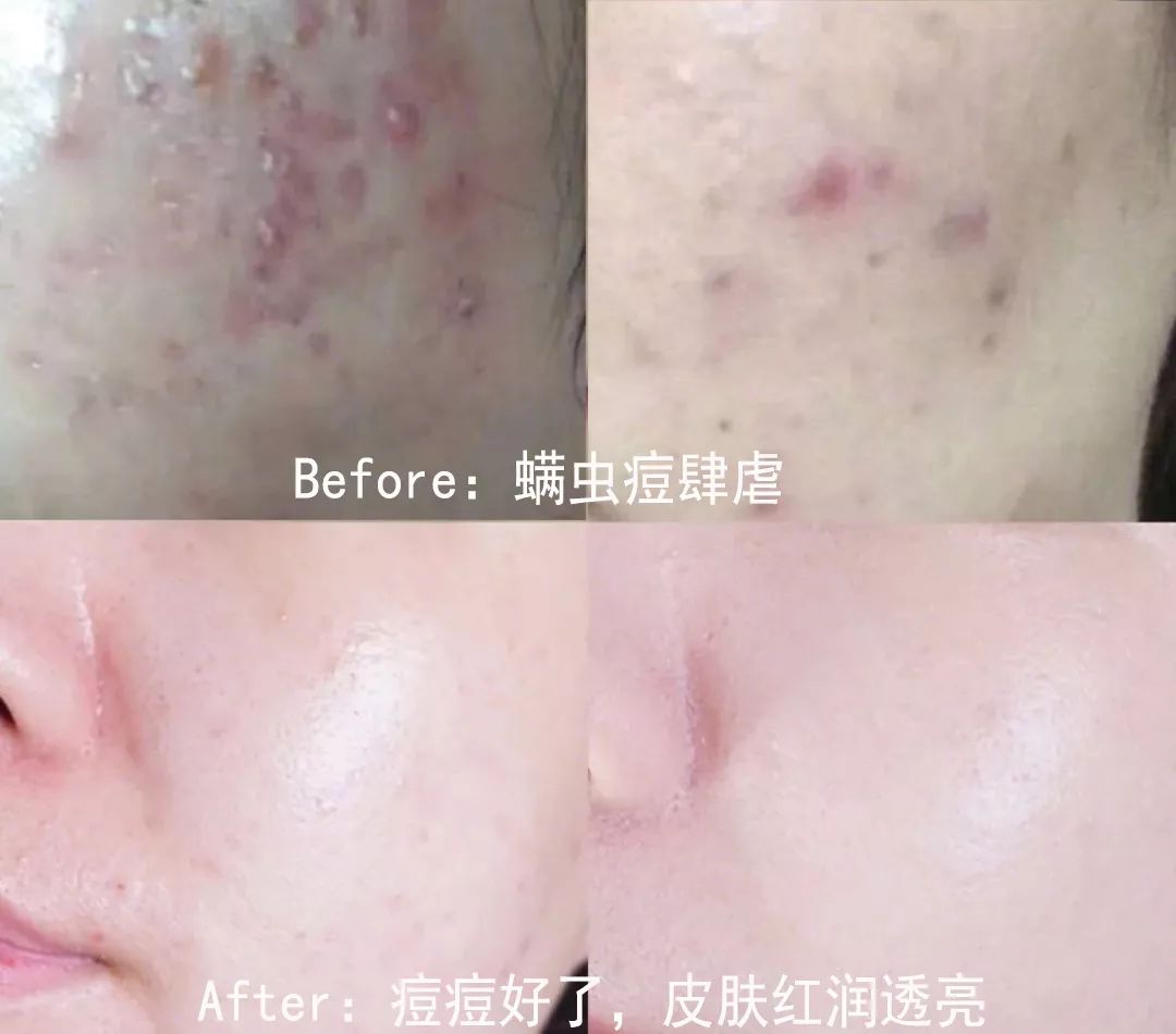 鼻头总是挤出白色丝条中医辨证,鼻头一挤就有白丝