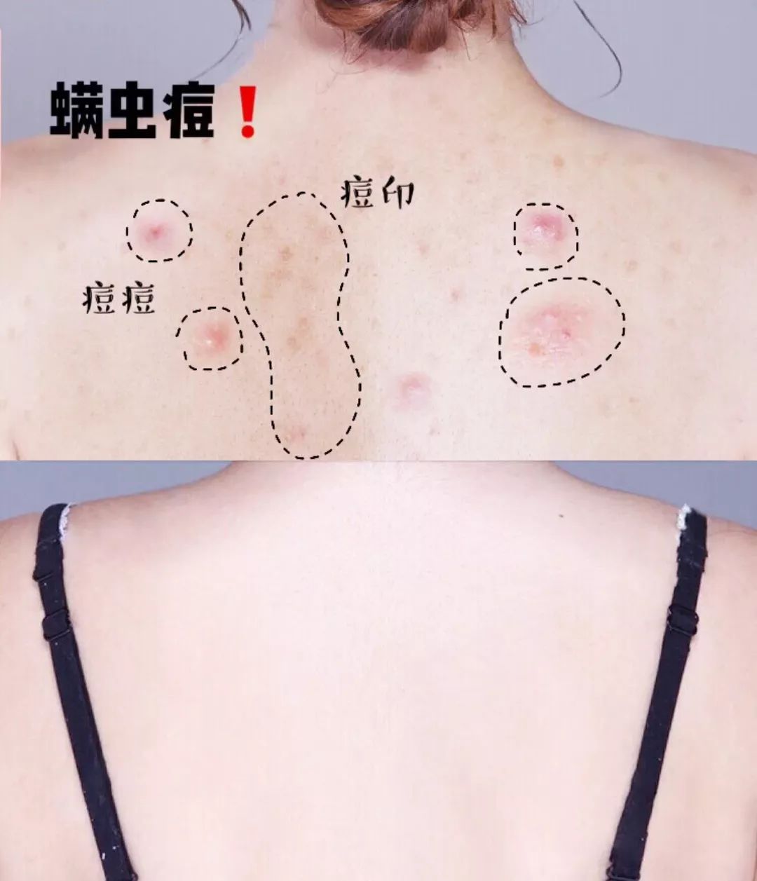 鼻头总是挤出白色丝条中医辨证,鼻头一挤就有白丝