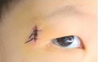 孩子脸摔破会留疤怎么办,小孩摔破脸会留疤吗