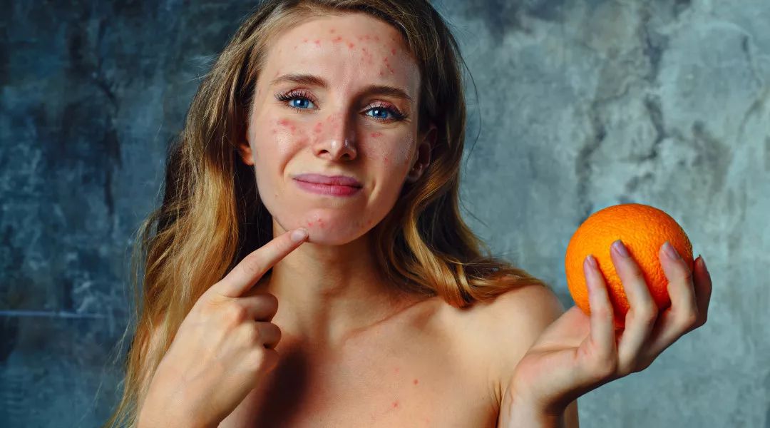 反复长痘怎么调理不用护理,反复长痘怎么办皮肤科医生来支招