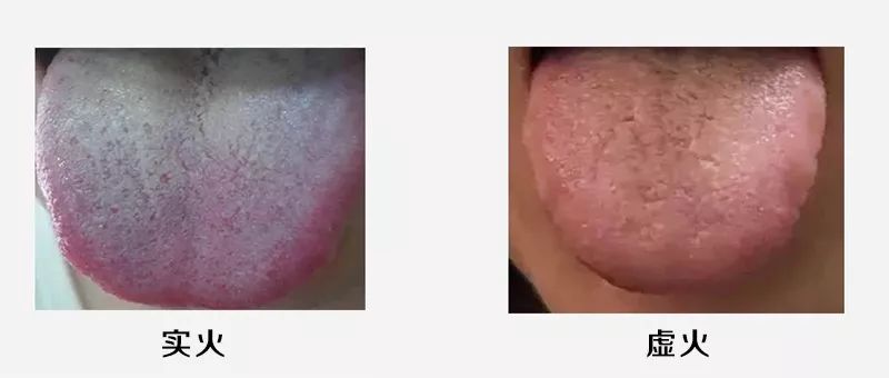 已经上火如何快速祛火,清火治上火最好的方法