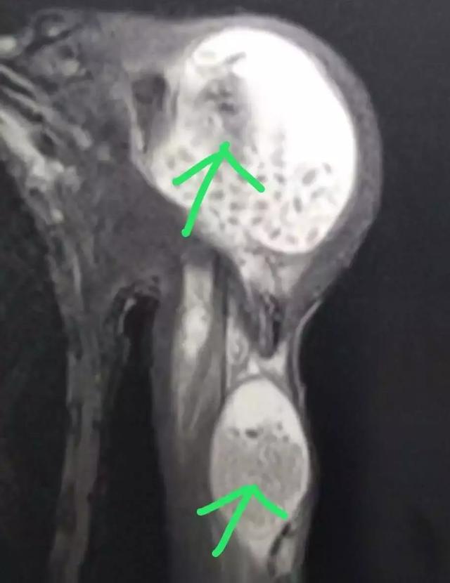 男子肩膀发现豌豆大结节,左肩上方一块肿大是怎么回事