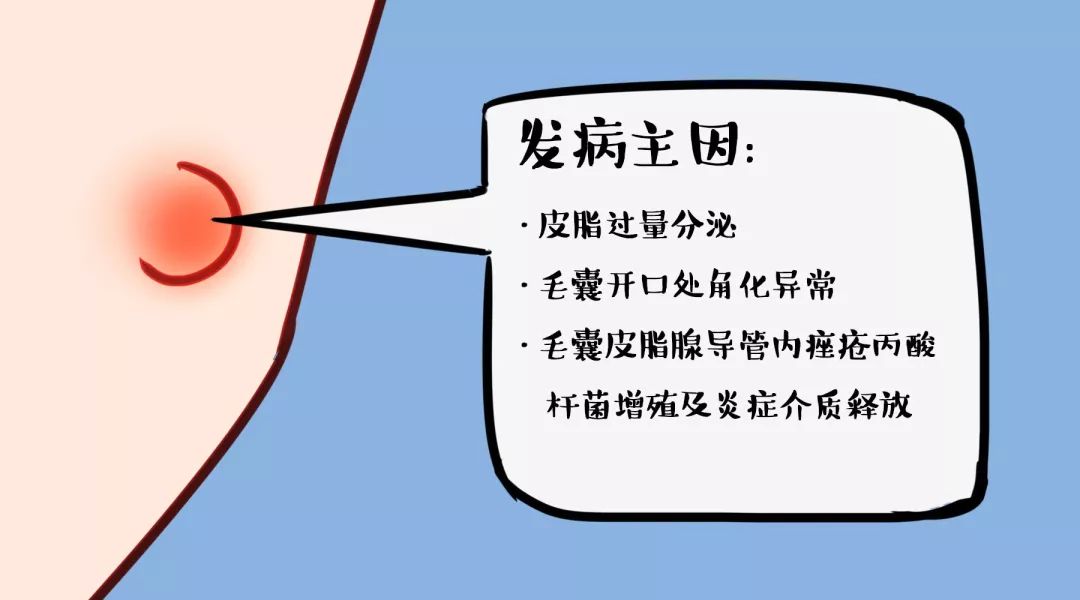 辟谣特工队|吃避孕药能战“痘”成功吗?