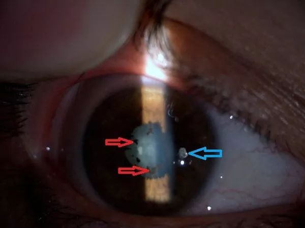 致密性骶髂关节炎与强直性脊柱炎,葡萄膜炎和布鲁氏关节炎