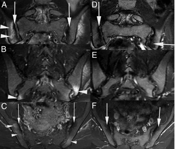 致密性骶髂关节炎与强直性脊柱炎,葡萄膜炎和布鲁氏关节炎
