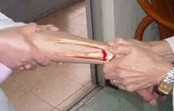 【筋骨堂】骨折到底需要手术吗