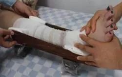 【筋骨堂】骨折到底需要手术吗