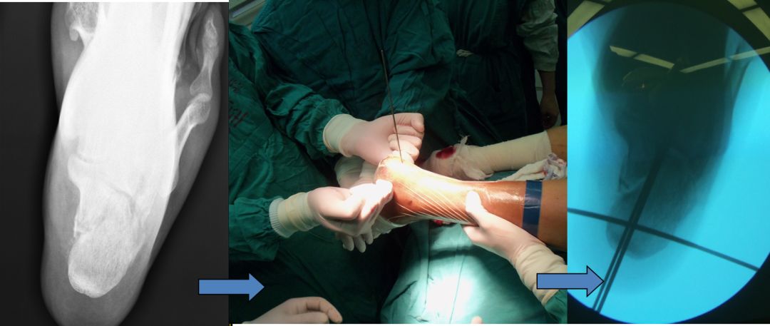 【筋骨堂】骨折到底需要手术吗