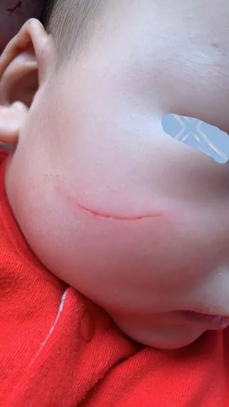 面部皮瓣美容缝合,面部美容线缝合恢复效果图