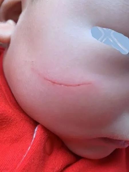 面部皮瓣美容缝合,面部美容线缝合恢复效果图