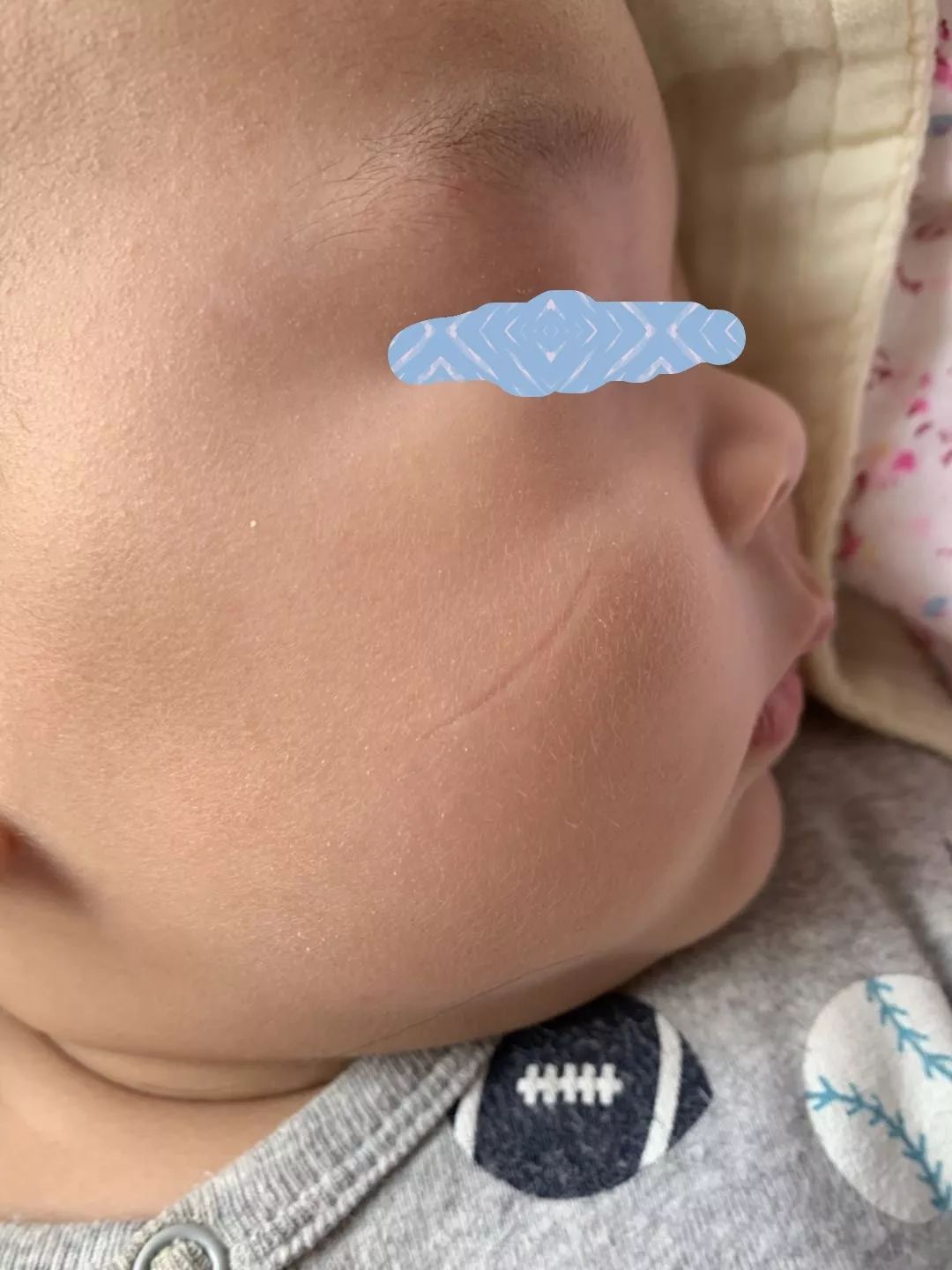 面部皮瓣美容缝合,面部美容线缝合恢复效果图