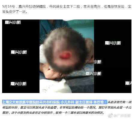 婴儿头上少一块皮肤,婴儿头上少块皮肤